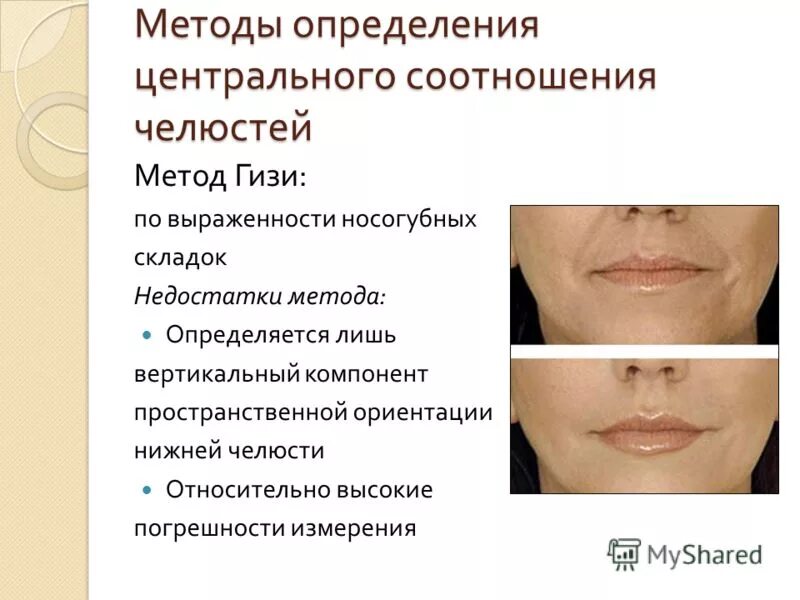 Определение и фиксация центральной окклюзии. Определение центрального соотношения. Методика определение соотношение центральной окклюзии челюстей. Этапы определения центрального соотношения челюстей. Этапы определения центрального соотношения челюстей.