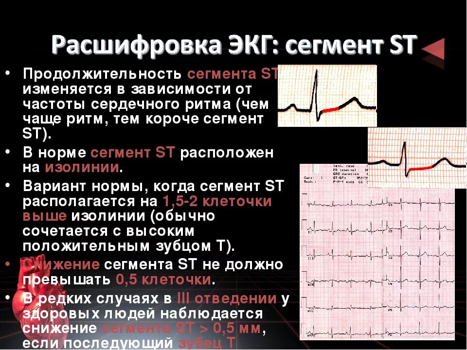 Умеренные метаболические изменения. ЭКГ сердца QRS норма. Патология комплекса QRS на ЭКГ. ЭКГ 2 отведение норма. ЭКГ зубец р в норме и при патологии.