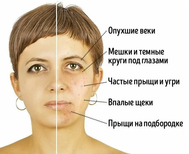Прыщи от молока на лице как выглядят Мезотерапия для лечения акне. Процедура в Москве в клинике Марины Рябус