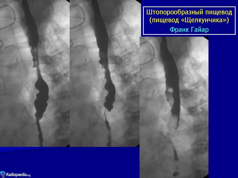 Пищевод шацкого. Пищевод Барретта рентген пищевода. Штопорообразный пищевод на рентгенограммах. Ахалазия и дивертикул пищевода.