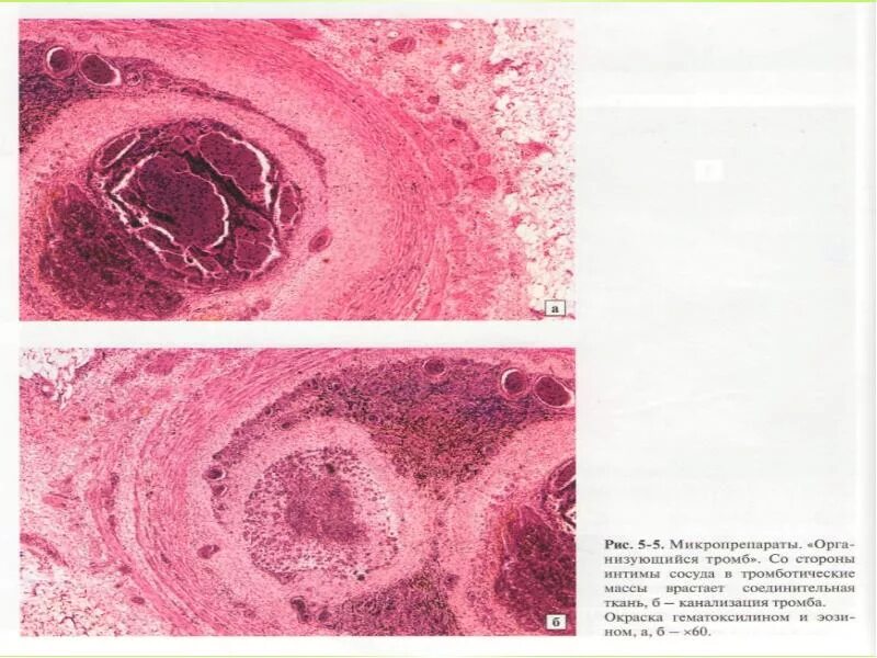 Организованный тромб в Вене микропрепарат. Организующийся тромб микропрепарат. Организованный тромб микропрепарат. Микропрепарат организкющий тромб. Организация тромба