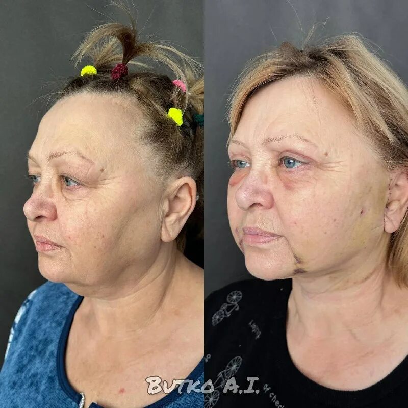 Круговая подтяжка лица гематомы. Хирургическая круговая подтяжка лица. Лицо сразу после подтяжки. Лазерная круговая подтяжка лица. Лицо сразу после подтяжки.