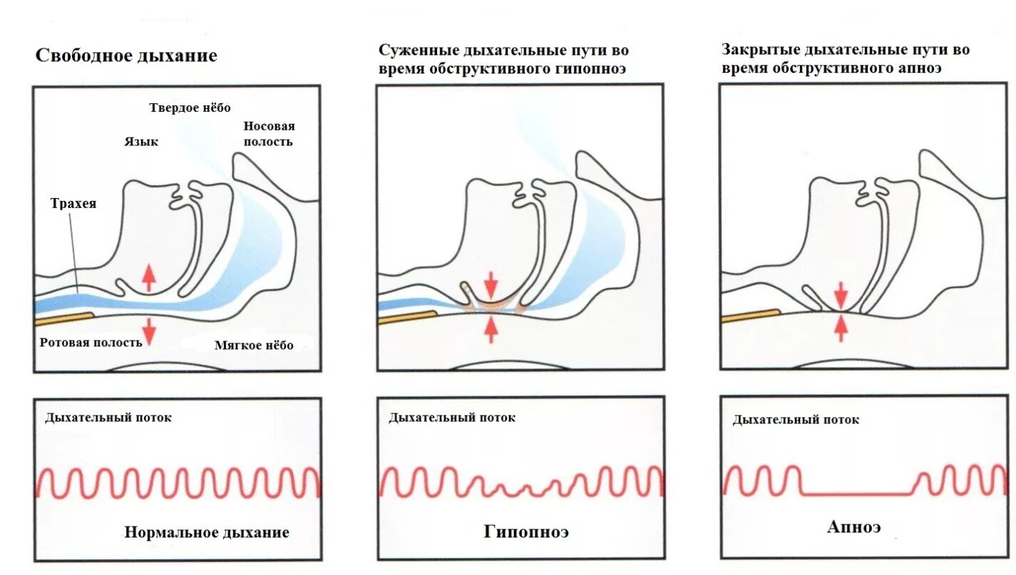 При засыпании останавливается дыхание. Синдром обструктивного апноэ гипопноэ сна. Синдром апноэ и гипопноэ сна.