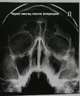 Киста в верхнечелюстной пазухе носа