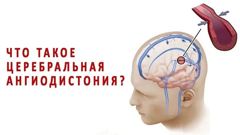 Ангиодистония сосудов. Ангиодистония сосудов головного мозга что это такое. Ангиодистония церебральных артерий. Церебральная агнеостания. Церебральная ангиодистония симптомы.