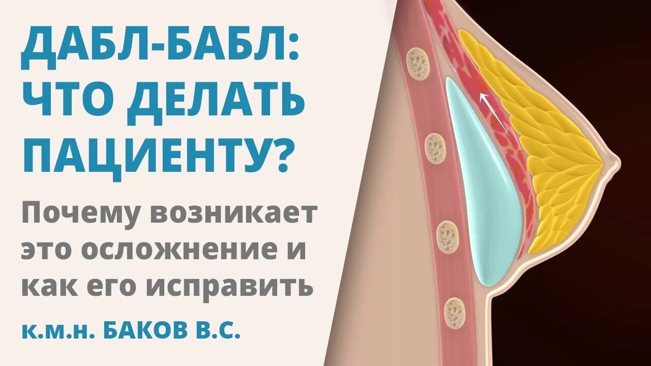 Дабл бабл алиса дабл бабл. Дабл Дабл осложнения после маммопластики. Дабл бабл маммопластика. Дабл бабл после маммопластики. Дабл бабл осложнение после маммопластики.