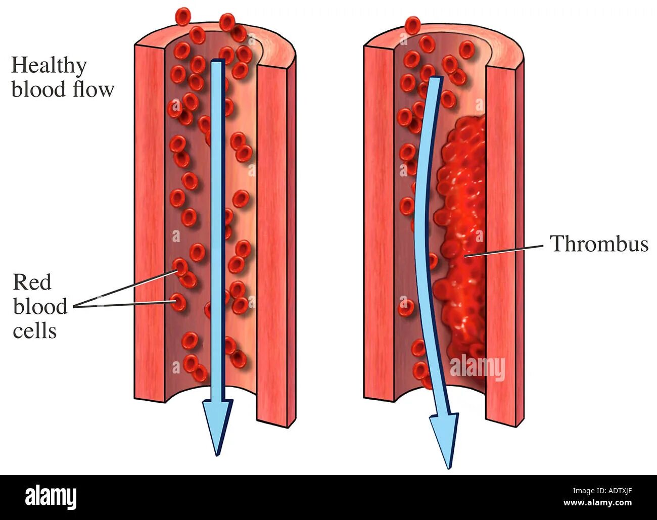 Тромбоз кровеносных сосудов. Размеры тромбов