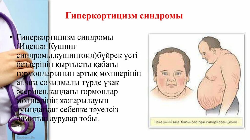 Болят ли надпочечники. Синдром Иценко-Кушинга (гиперкортицизм). Болезнь Иценко Кушинга ожирение. Синдром Иценко -Кушинга надпочечники. Надпочечники при синдроме Иценко-Кушинга.