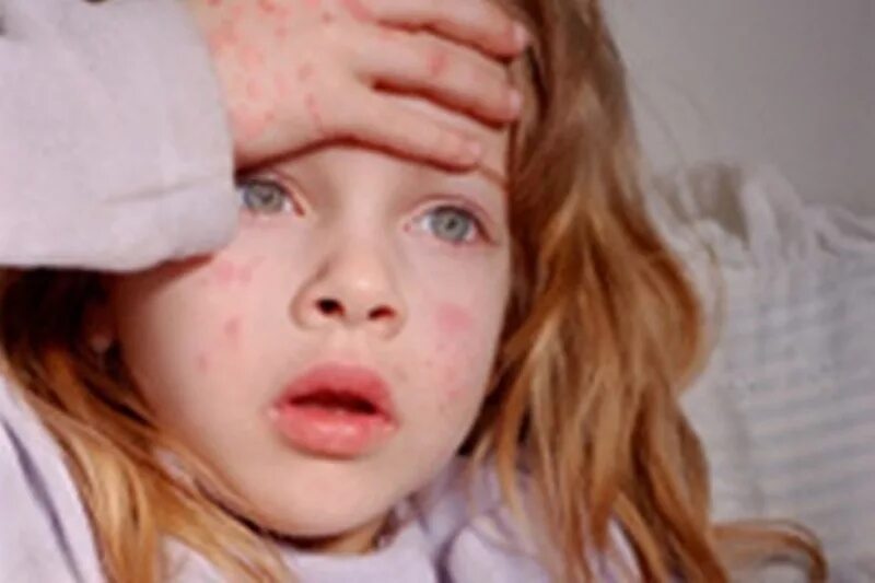 Анафилактический шок у детей. Аллергическая реакция у детей. Анафилактический ШОК кожа.