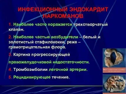 Эндокардит возбудители