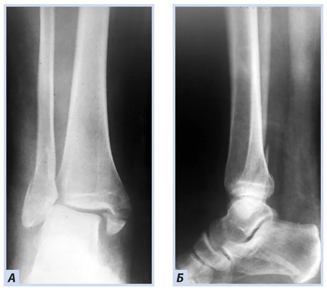 Перелом голеностопного сустава. Дистальный метаэпифиз малоберцовой кости перелом. Перелом метафиза малоберцовой кости. Перелом большеберцовой кости и малоберцовой кости. Перелом дистального отдела большеберцовой кости.