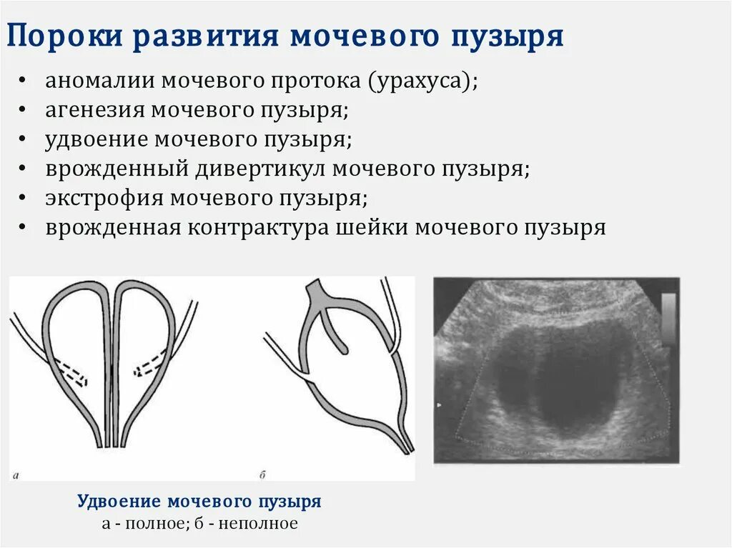 Дивертикул мочевого пузыря что это такое. Пороки развития мочевого пузыря. аномалии развития мочевого пузыря. удвоение мочевого пузыря. агенезия мочевого пузыря.