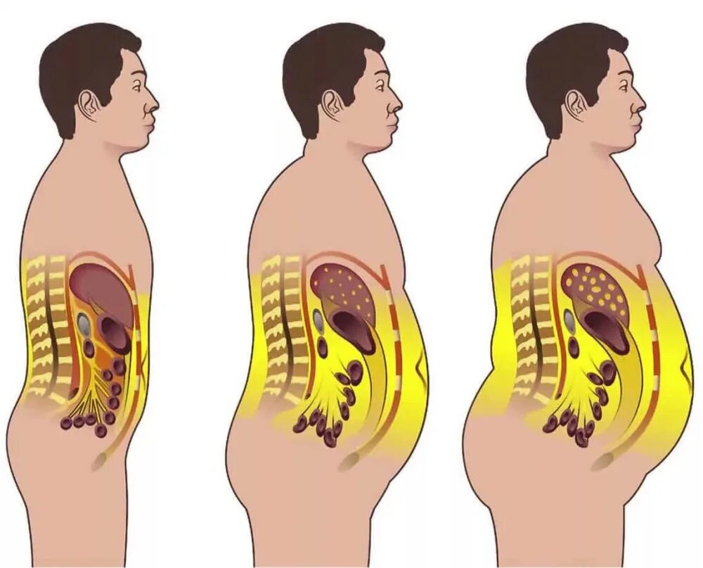 Почему быстро растет живот. Живот растет. Растёт живот у женщин причины. Воспаление висцерального жира.