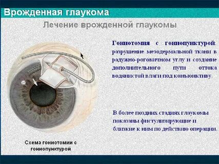 Глаукома мкб 10 у взрослых