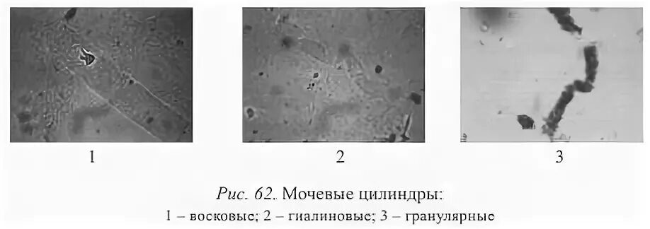 Моча цилиндры гиалиновые повышенные. Гиалиновые цилиндры. Гиалиновые цилиндры норма. Гиалиновые цилиндры образуются. Гиалиновый цилиндр в моче микроскопия.