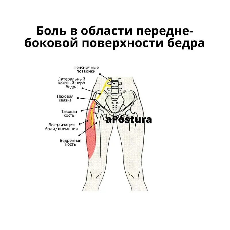 Наружный кожный нерв бедра анатомия. Невралгия бедренного нерва. Невралгия бедренного нерва. Невралгия бедренного нерва. Неврит бедренного нерва неврология.