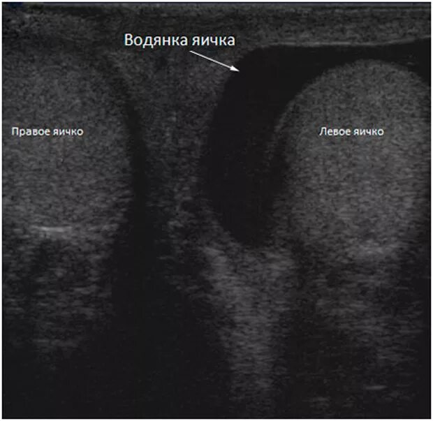 Одно яичко стало. Гидроцеле яичка у детей на УЗИ. УЗИ критерии гидроцеле. Водянка оболочек яичка УЗИ.