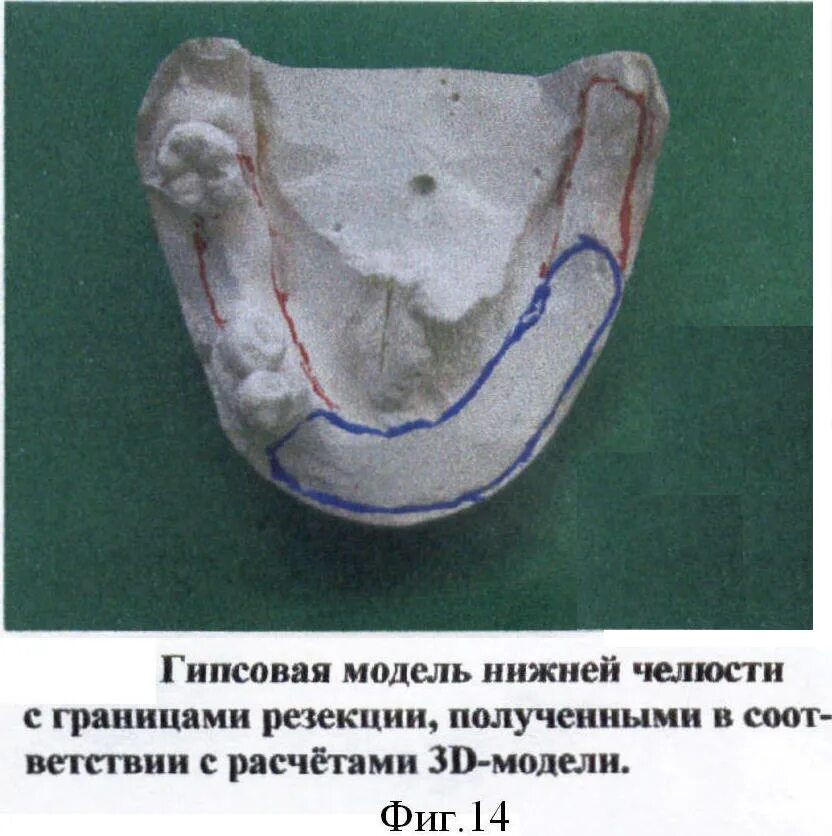 Границы пластиночного протеза. Границы базиса на верхней челюсти. Границы базиса протеза на нижней челюсти. Границы протеза на нижнюю челюсть. Границы базиса протеза на верхней челюсти.