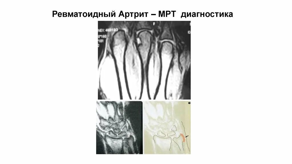 Осмотр при ревматоидном артрите