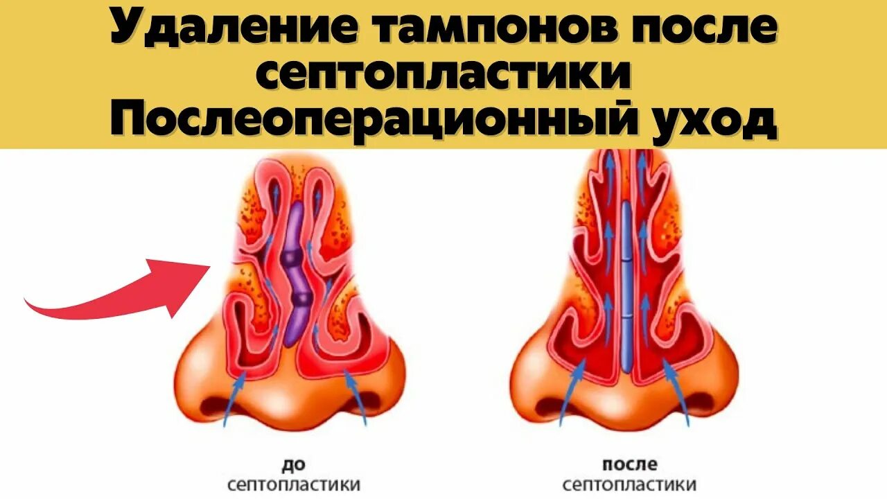 Тампоны после септопластики. Искривление перегородки носа. Снятие тампонов после септопластики. Септопластика носа тампоны.