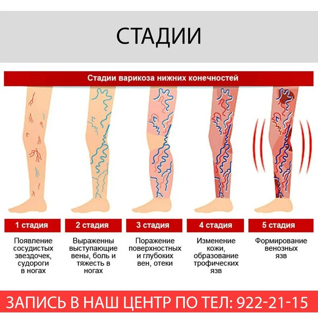 Varicose and Spider Veins Treatment in Dubai - Laser Skin Care Clinic Dubai