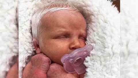Ребенок родился с седым волосом