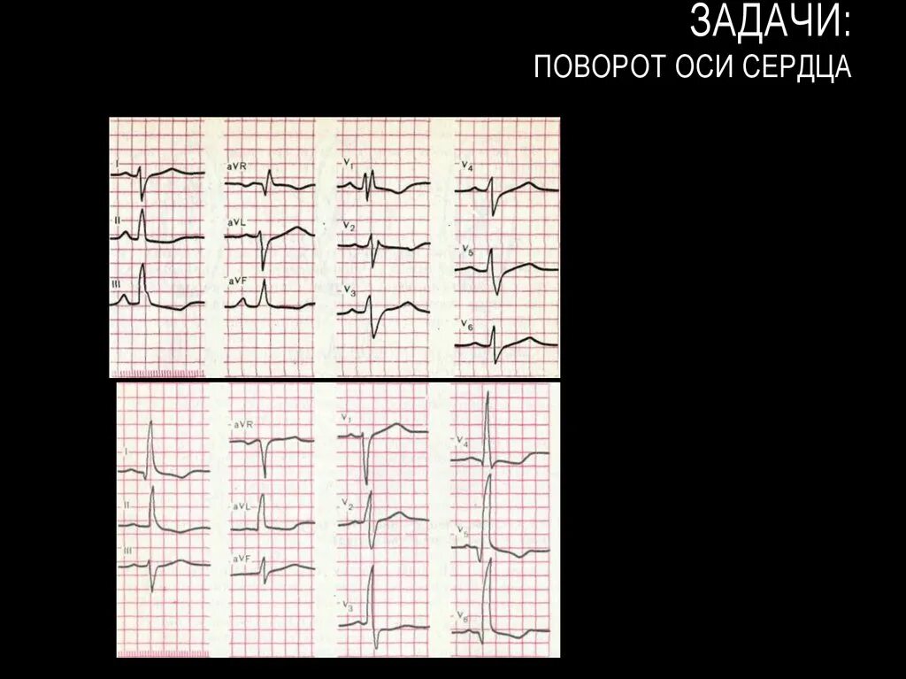 Поворот сердца верхушкой кзади на ЭКГ. Поворот сердца верхушкой вперед на ЭКГ. ЭКГ при поворотах сердца вокруг продольной оси. Поворот сердца верхушкой кпереди на ЭКГ. Поворот правым желудочком вперед