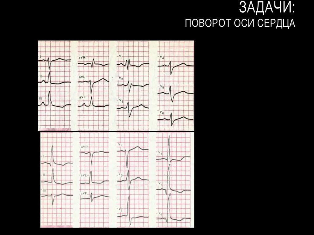 Поворот сердца правым желудочком вперед что это. Поворот сердца верхушкой кзади на ЭКГ. Поворот сердца верхушкой вперед на ЭКГ. ЭКГ при поворотах сердца вокруг продольной оси. Поворот сердца верхушкой кпереди на ЭКГ.