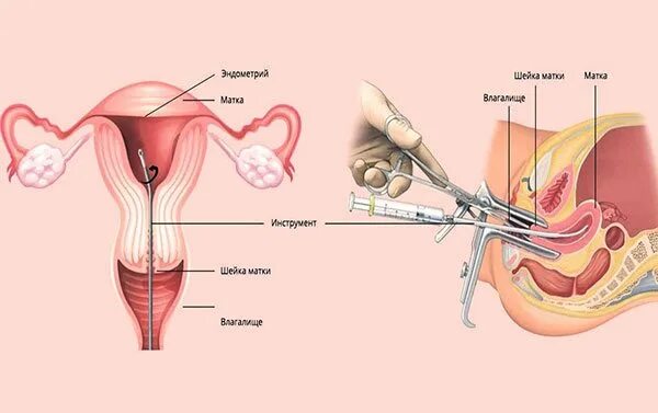 Маточное выскабливание. Раздельное диагностическое выскабливание полости матки. Выскабливание цервикального канала шейки. Раздельное диагностическое выскабливание слизистой цервикального. Гистероскопия с раздельным диагностическим выскабливанием.