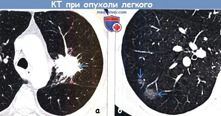 Очаги в нижней доле легкого. Очаговый пневмофиброз кт. Аденокарцинома легких на кт. Фиброз легкого на кт.