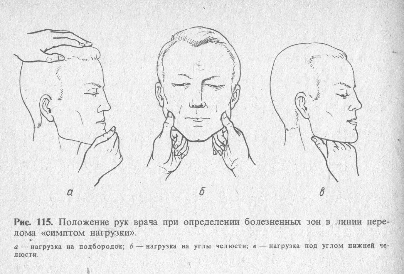 Симптом непрямой нагрузки. Симптом нагрузки при переломах. Патогномоничные признаки перелома. Симптом осевой нагрузки. Симптом нагрузки при переломах нижней челюсти.