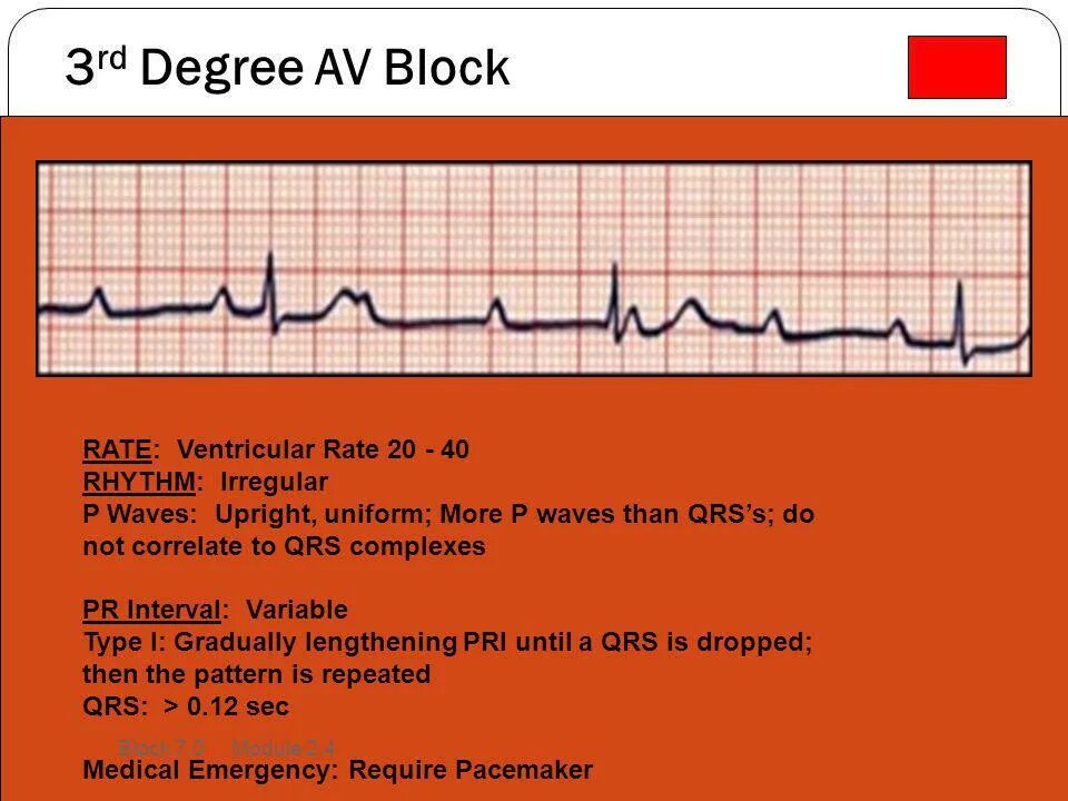 Block rate. Sinoatrial blockade 3 degree ecg. Block rate. Block rate. Block rate.