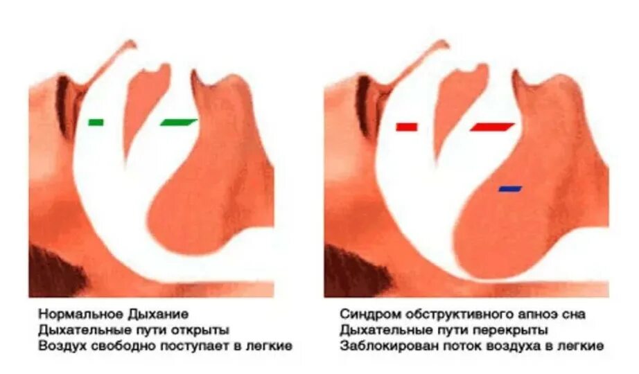 При засыпании останавливается дыхание. Синдром обструктивного апноэ сна. Западение языка при апноэ.