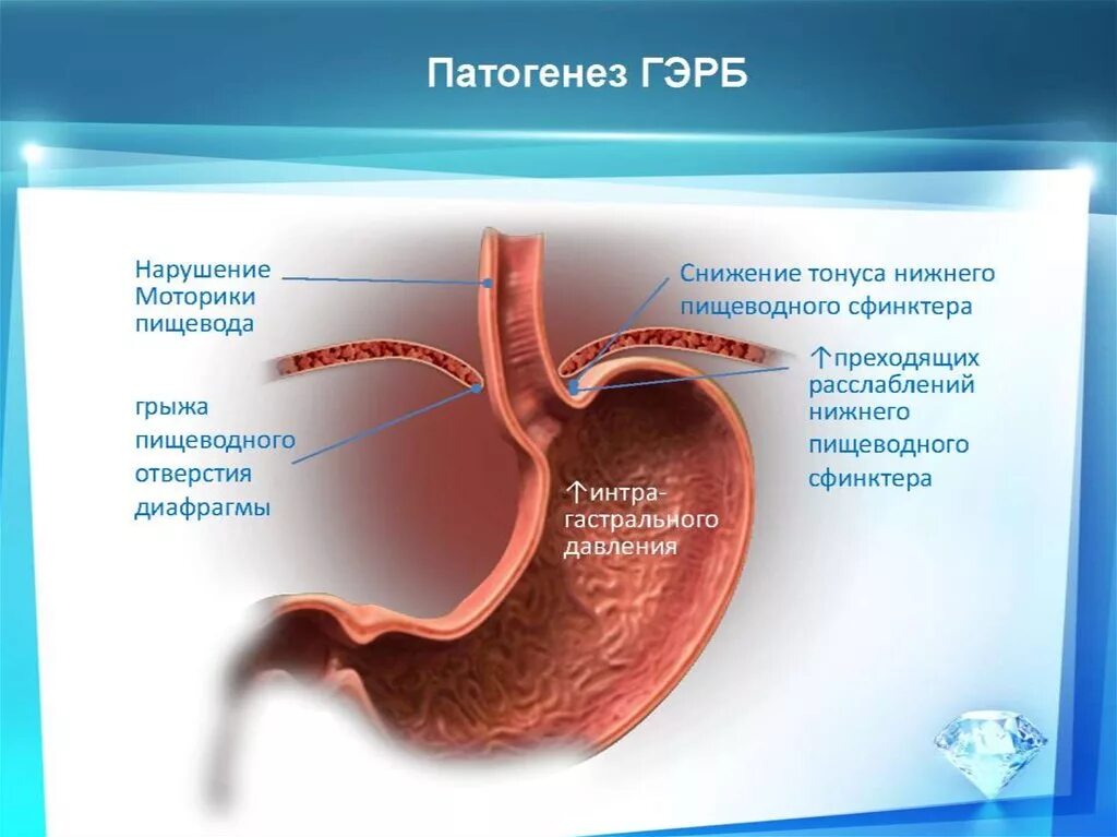 Нижний пищевод. Гастроэзофагеальная рефлюксная болезнь этиология. Рефлюксная болезнь сфинктер. ГЭРБ механизм развития. Гастроэзофагеальная рефлюксная болезнь патогенез.