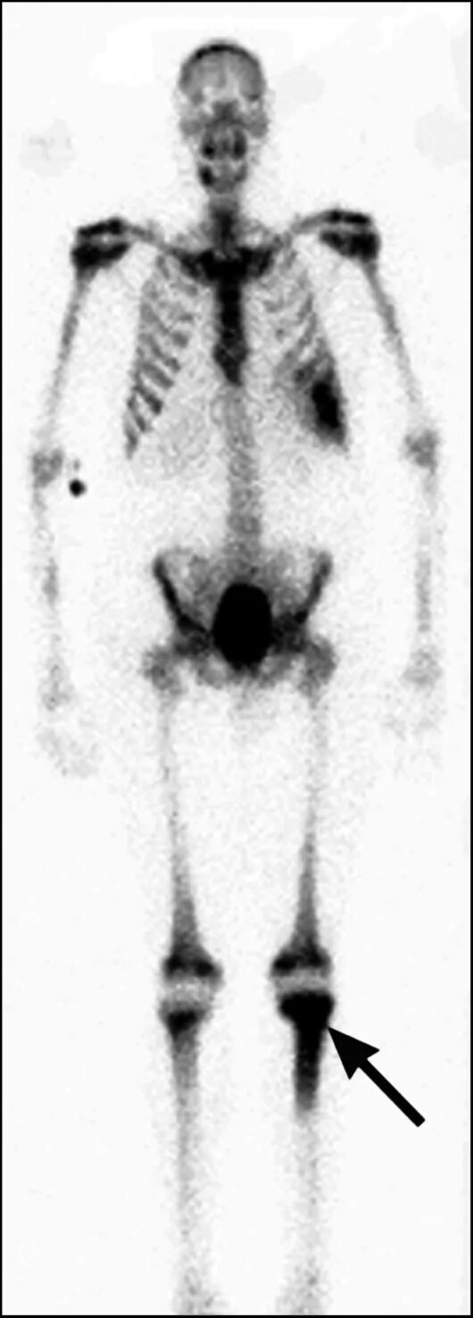 Метастатическое поражение кости. Сцинтиграфия метастазы очаг. Сцинтиграфия костей метастазы. Сцинтиграфия остеомиелит. Остеосцинтиграфия очаги гиперфиксации.