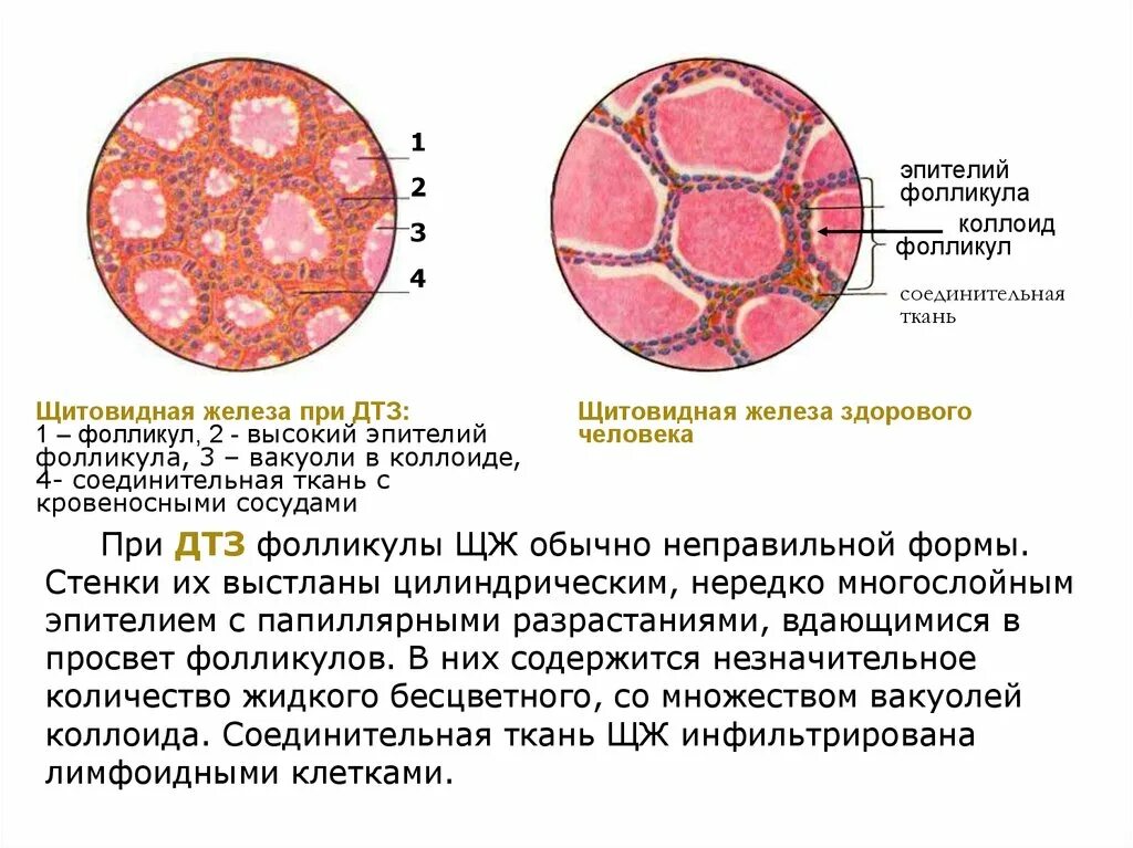 Фолликул щитовидной железы что это. Эпителий фолликулов щитовидной железы. Коллоид фолликулов щитовидной. Уплощенный эпителий кистовидных фолликулов. Фолликулы щитовидной железы выстланы эпителием.