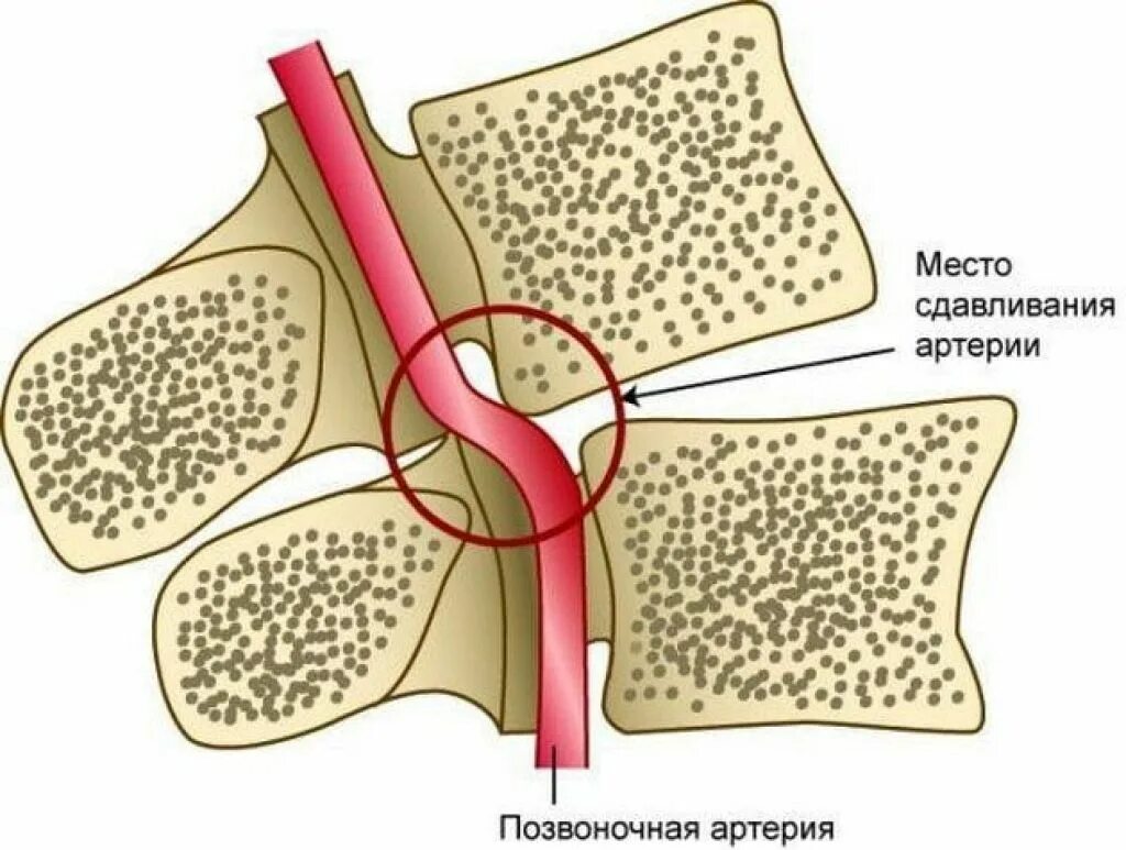 Сдавление спинного. Синдом позвоночной артерии. Сдавливание позвоночных артерий. Сдавление позвоночной артерии. Сдавление позвоночной артерии шейного отдела.