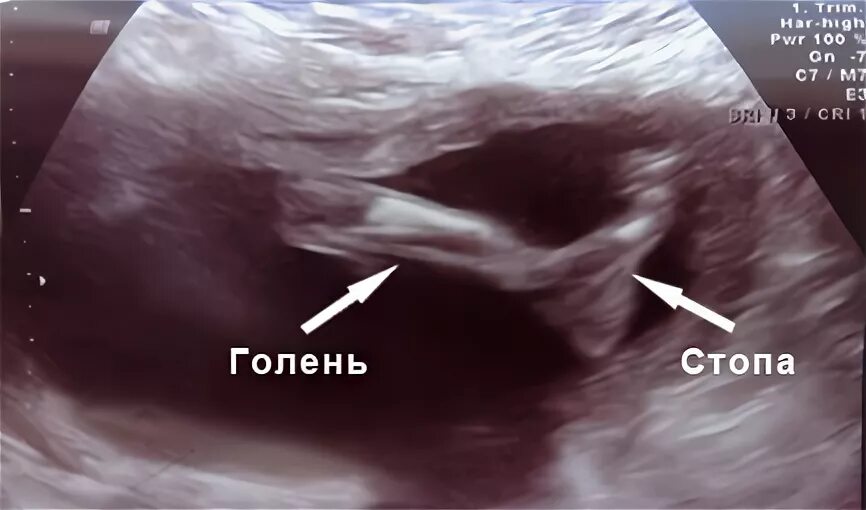 УЗИ 36 недель беременности. Узи на 36 неделе
