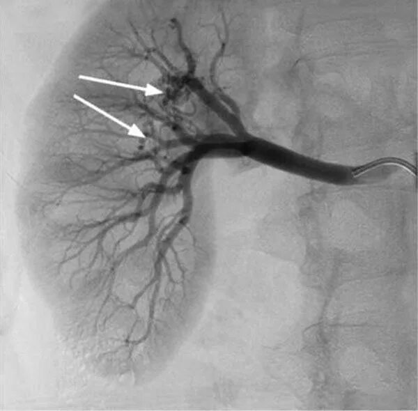 Артериовенозная мальформация ангиограмма. Артериовенозная фистула аневризма. Узелковый полиартериит. Узелковый полиартериит ангиография. Тромбоз почечной артерии