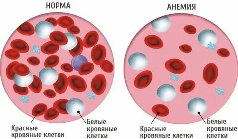 Тяжелая анемия какой гемоглобин
