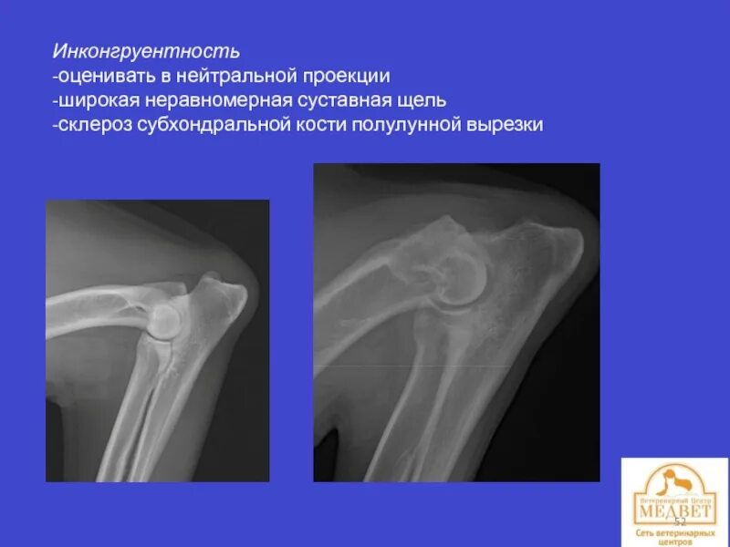 Суставная щель склерозированы. Суставная щель неравномерна. Суставная щель неравномерна. Полулунная вырезка кости. Суставная щель коленного сустава норма.