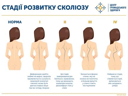 Сколиоз клинические рекомендации