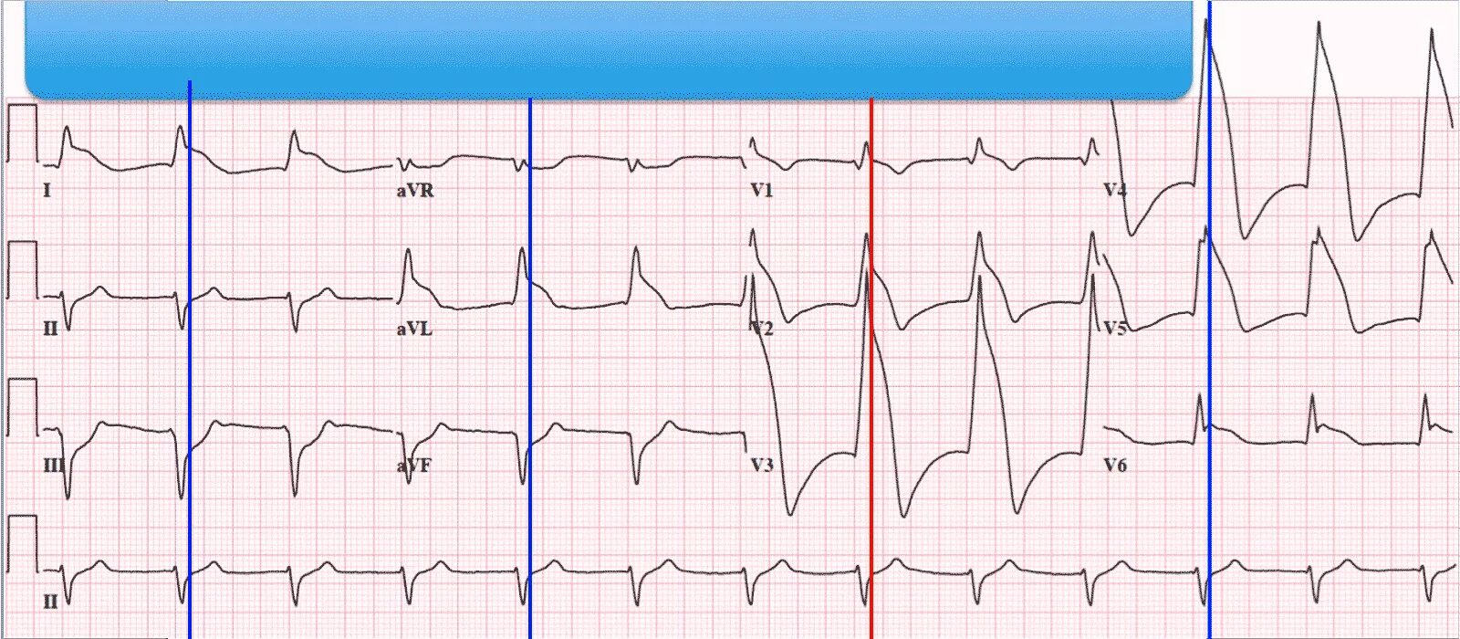 Зубцы р после qrs. Экг v1 v2 v3 v4 v5 v6 расшифровка. qrs на экг в v 1. отрицательный зубец s v1, v2, v3. отрицательный зубец т на экг в 1 отведении.