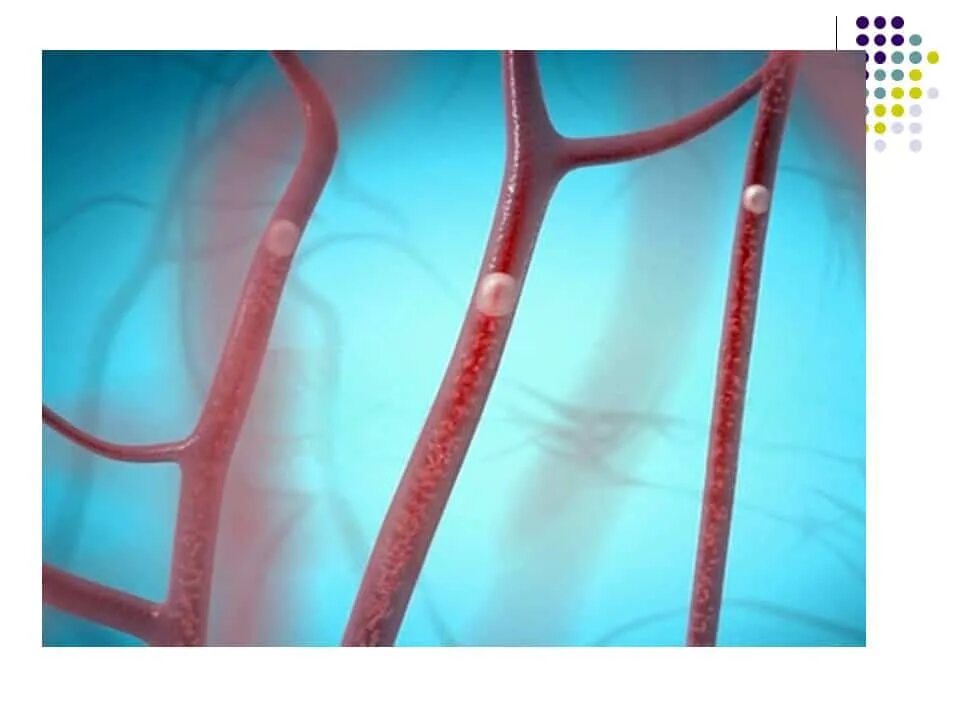 воздушная, газовая, жировая эмболия. что закупоривает сосуд при газовой эмболии. признаки эмболии. воздушная эмболия механизм развития. эмболия артериального сосуда.