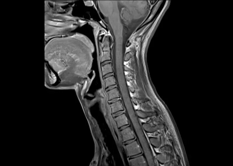 Мрт шейного отдела позвоночника норма. Мрт шейного отдела норма. Снимок мрт норма шейный отдел. Мрт шейного отдела позвоночника Екатеринбург.