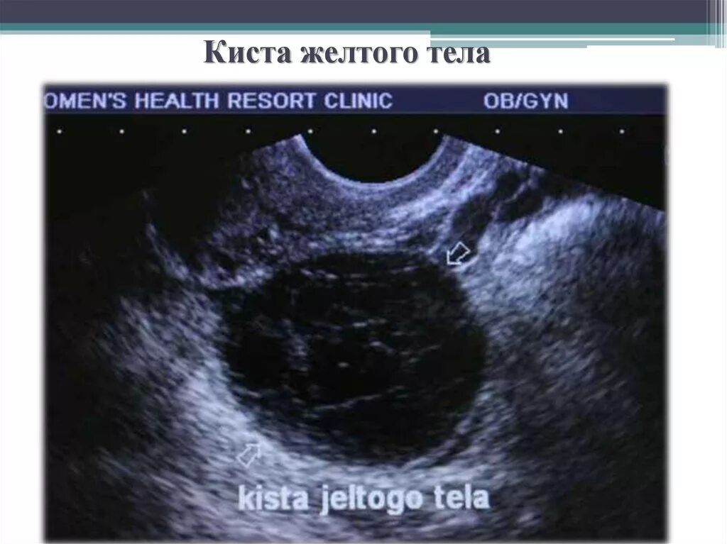 Можно перепутать беременность с кистой. Регрессирующая киста желтого тела. Яичников УЗИ киста желтого тела. Фолликулярная киста яичника на УЗИ. Киста желтого тела яичника дифференциальная.