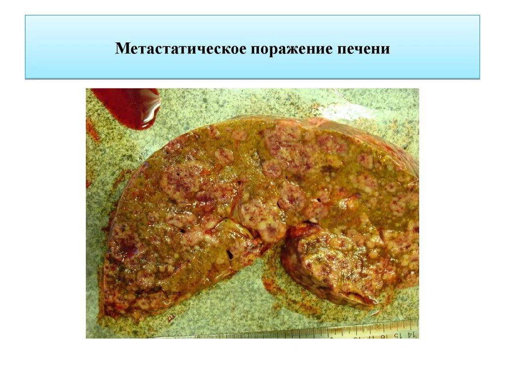 Метастатическое поражение печени. Метастатические опухоли печени. Вторичные (Метастатические) опухоли печени. Вылечить метастазы в печени