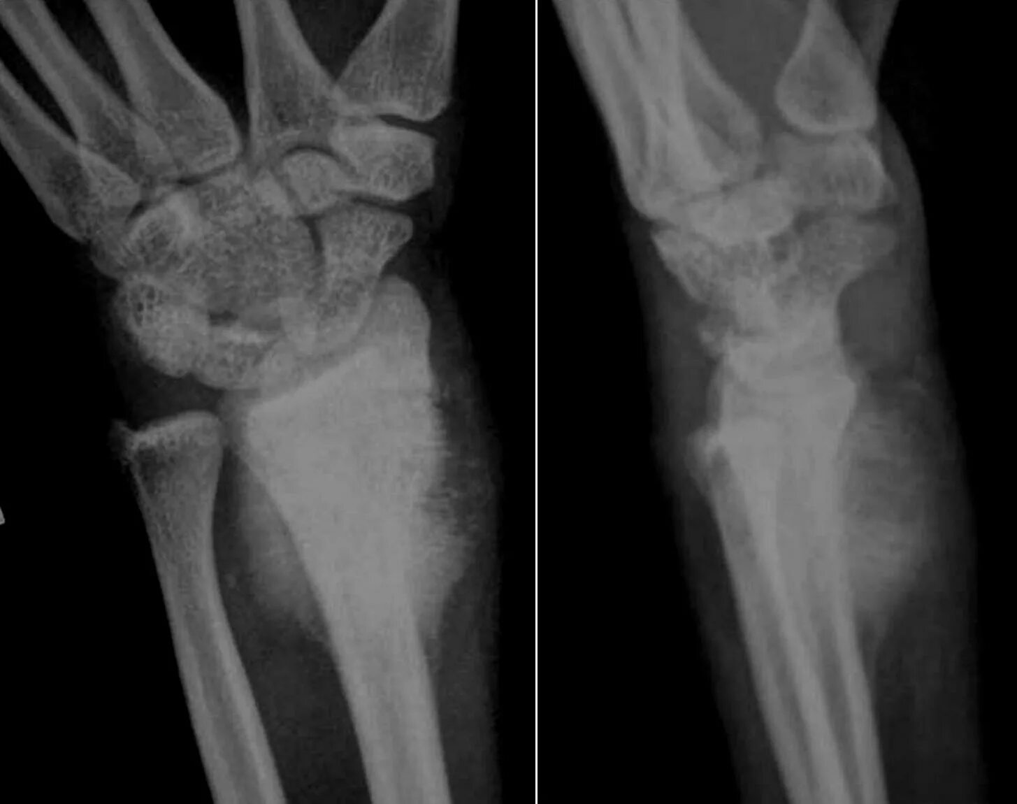 Остеосаркома бедренной кости рентген. Что такое саркома кости. Остеосаркома малоберцовой кости. Остеосаркома большеберцовой кости рентген. Хондросаркома бедренной кости.