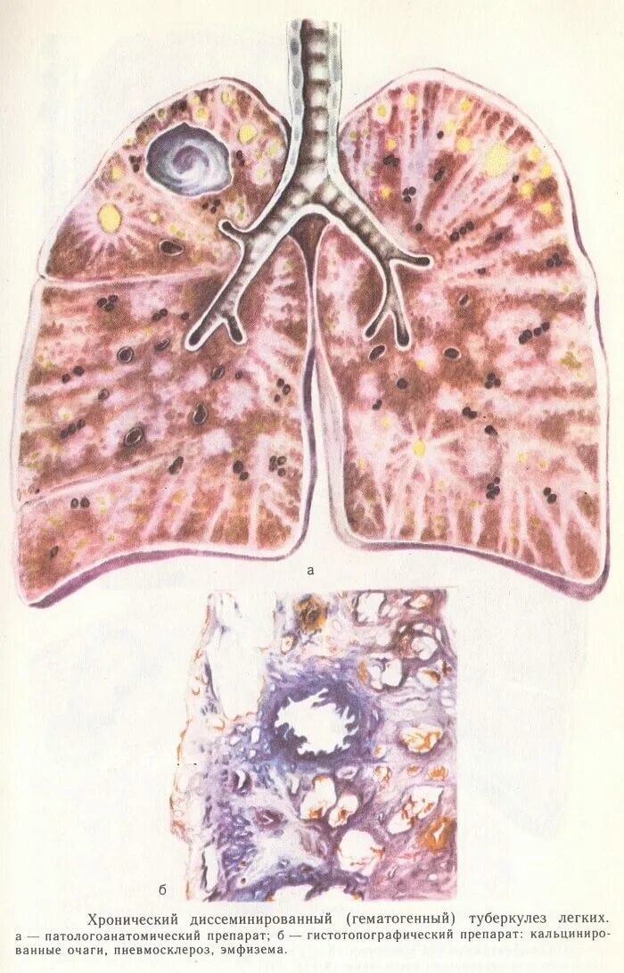 Старый туберкулез. Крупноочаговый диссеминированный туберкулез. Диссеминированный туберкулез патанатомия. Гематогенно-диссеминированный туберкулез легких макропрепарат. Хронический диссеминированный туберкулез.