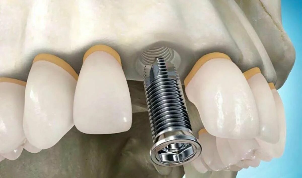 Имплантация формирователь Osstem. Имплант зуба абатмент. Дентальный имплантат Титан.